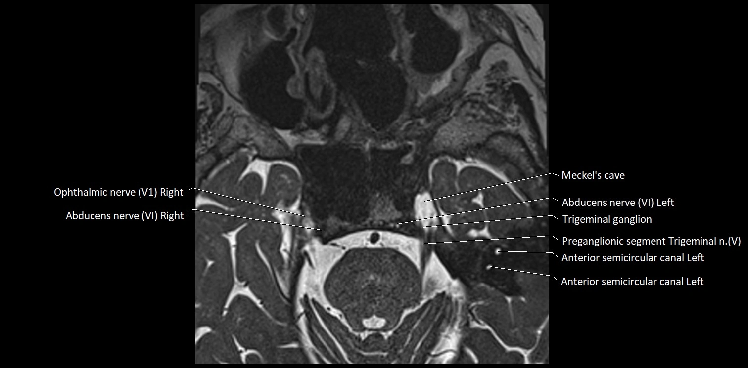 Cranial nerve anatomy axial MRI 3T image 40.webp